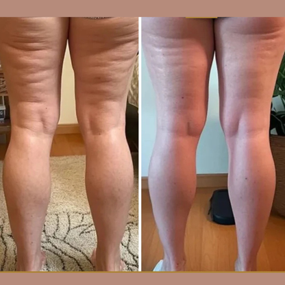 THE CELLULITE RELIEF MASSAGER™ - Luxurious At Home Cellulite Reduction, With Advanced Suction & Massage Technology For Smooth, Firm Skin.