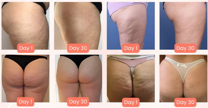 THE CELLULITE RELIEF MASSAGER™ - Luxurious At Home Cellulite Reduction, With Advanced Suction & Massage Technology For Smooth, Firm Skin.