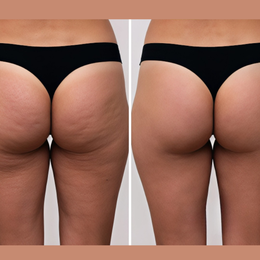 THE CELLULITE RELIEF MASSAGER™ - Luxurious At Home Cellulite Reduction, With Advanced Suction & Massage Technology For Smooth, Firm Skin.